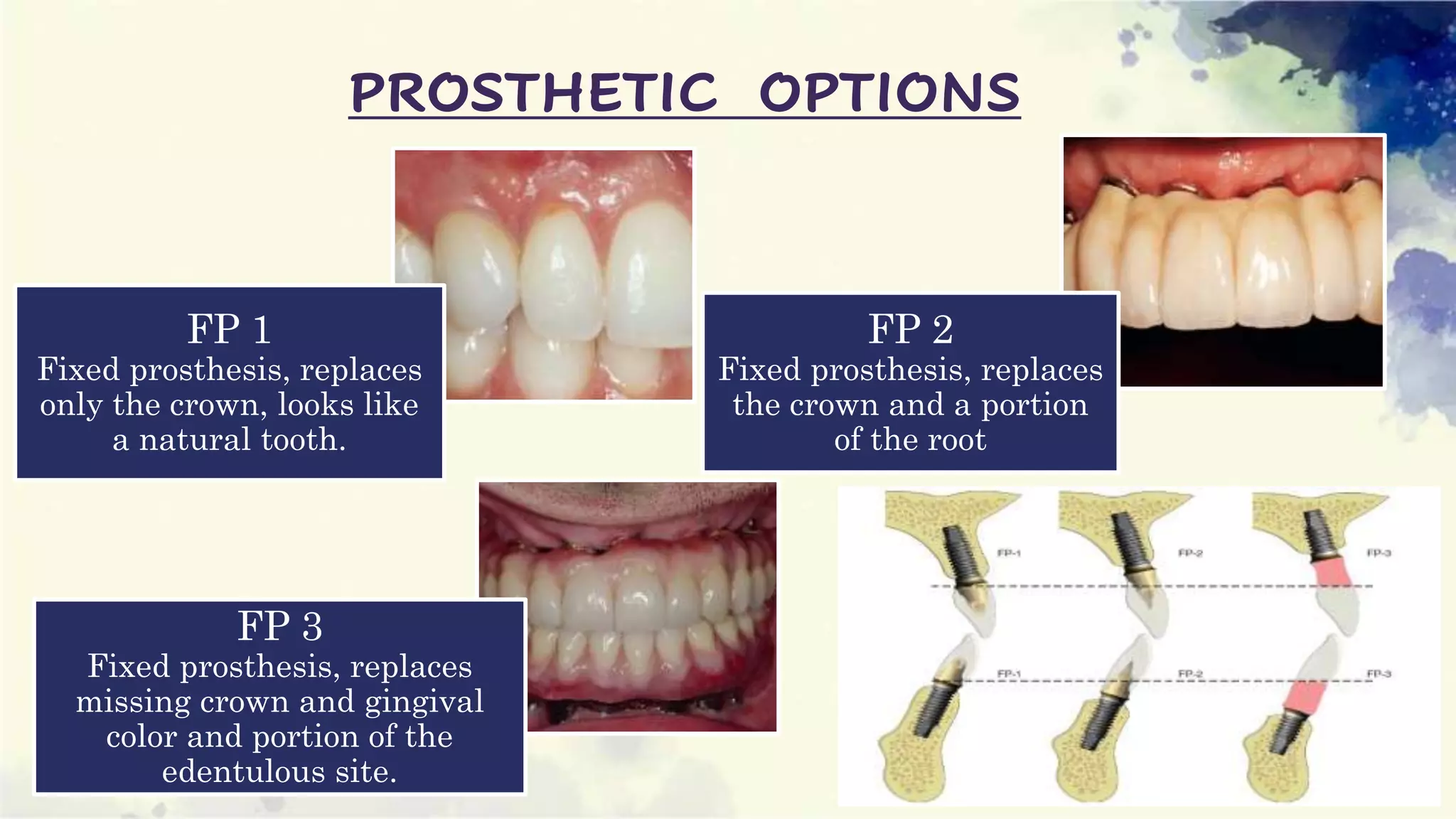 Implant supported overdenture | PPTX