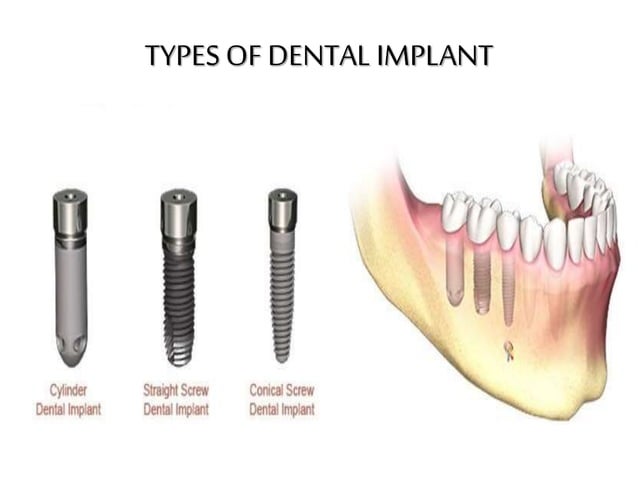 Implants (biomaterials) | PPT