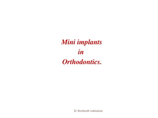 Mini implants
in
Orthodontics.
Dr Ravikanth Lakkakula
 
