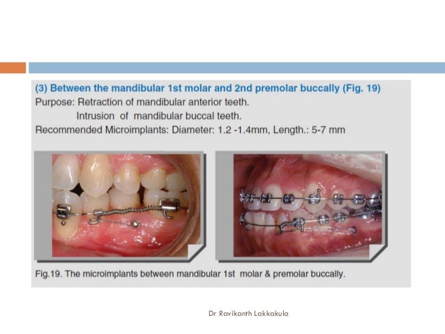 tad orthodontics