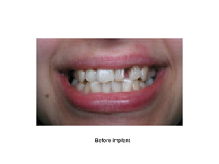 Before implant
 