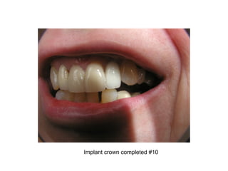 Implant crown completed #10
 