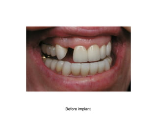 Before implant
 