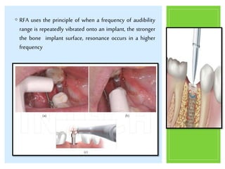 Implant stability1 | PPTX