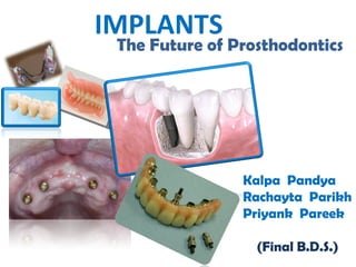 IMPLANTS   The Future of Prosthodontics  Kalpa  Pandya Rachayta  Parikh Priyank  Pareek (Final B.D.S.) 