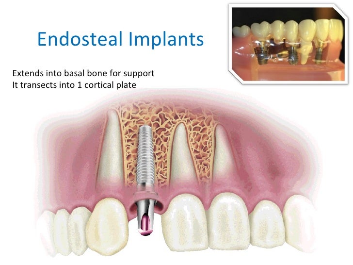 Implants the future of prosthodontics