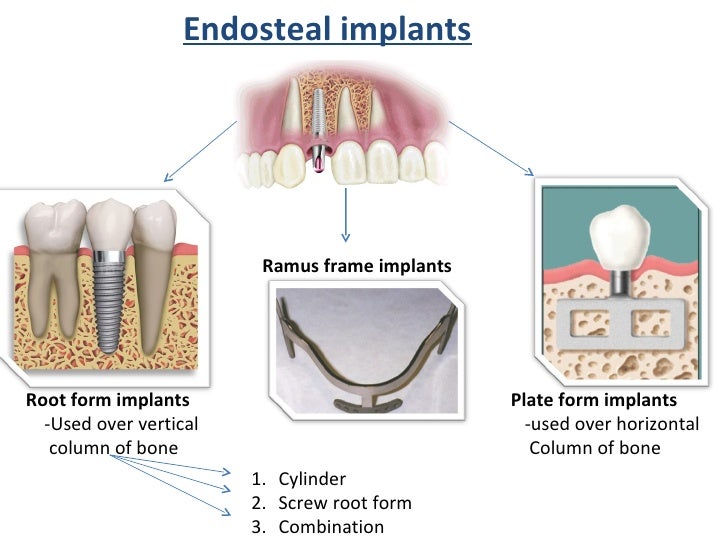 requirement h form Implants prosthodontics future of the requirement h form Implants prosthodontics future of the