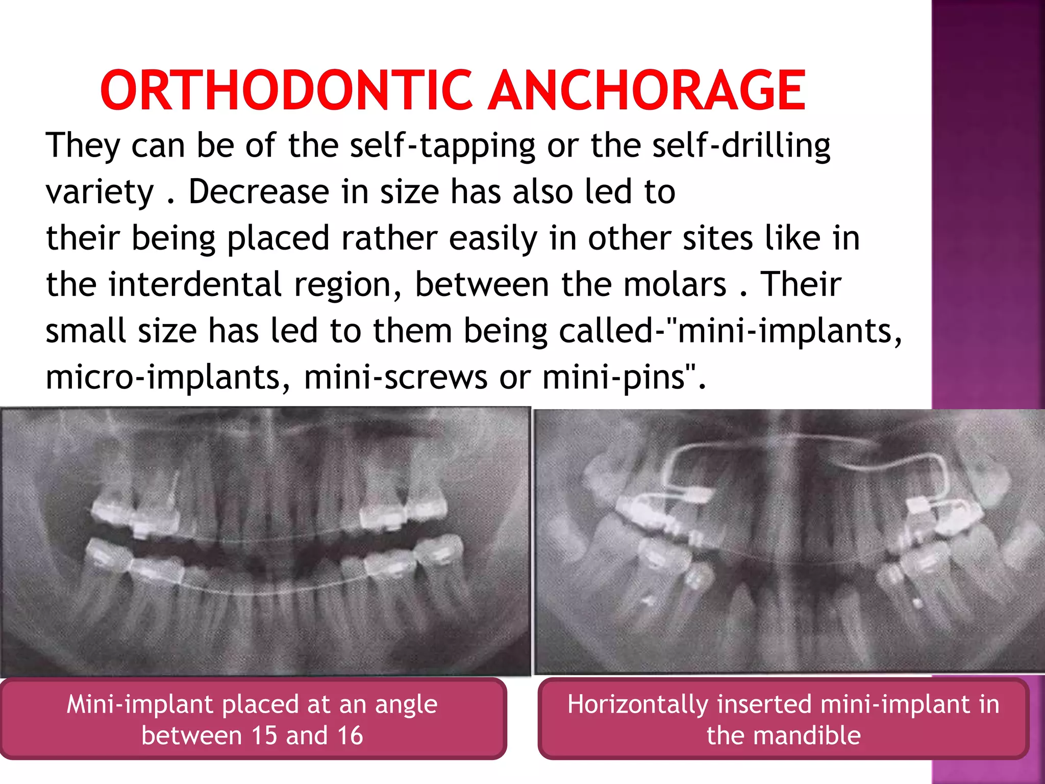 Mini Screw Invisalign Implants to miniscrews | PPTX