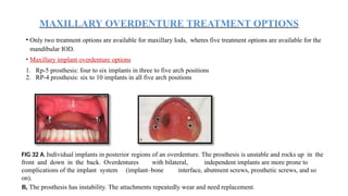 Maxillary Rp implant supported overdenture by Dr kavan doshi | PPTX