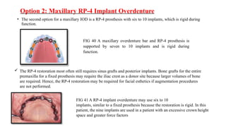 Maxillary Rp implant supported overdenture by Dr kavan doshi | PPTX