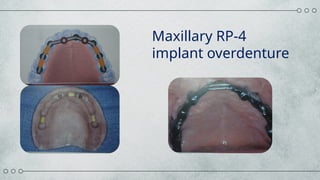 Maxillary Rp Implant supported overdenture.powerpoint | PPTX