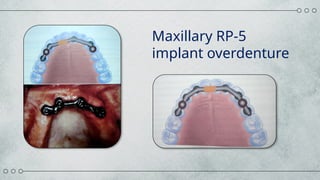 Maxillary Rp Implant supported overdenture.powerpoint | PPTX