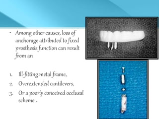 • Among other causes, loss of
anchorage attributed to fixed
prosthesis function can result
from an
1. Ill-fitting metal frame,
2. Overextended cantilevers,
3. Or a poorly conceived occlusal
scheme .
 