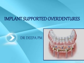 DR DEEPA PM
IMPLANT SUPPORTED OVERDENTURES
 
