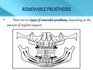 REMOVABLE PROSTHESES
• There are two types of removable prostheses, depending on the
amount of implant support.
 