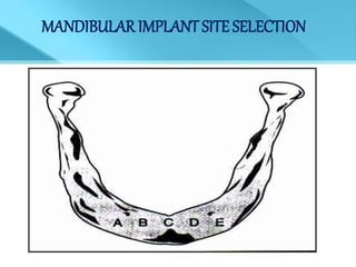 MANDIBULAR IMPLANT SITE SELECTION
 