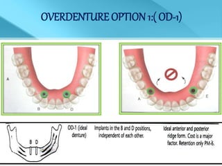 OVERDENTURE OPTION 1:( OD-1)
 