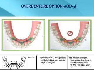 OVERDENTURE OPTION 3(OD-3)
 