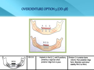 OVERDENTURE OPTION 3 (OD-3B)
 