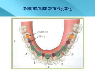 OVERDENTURE OPTION 5(OD-5)
 