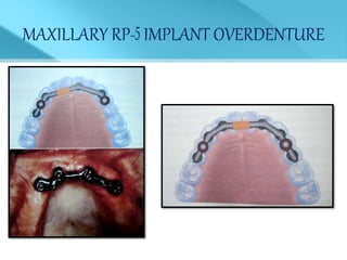 MAXILLARY RP- IMPLANT OVERDENTURE
 