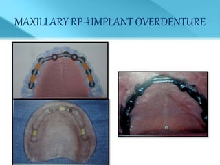 MAXILLARY RP- IMPLANT OVERDENTURE
 
