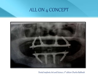 ALL ON 4 CONCEPT
Dental implants Art and Science, 2nd edition Charles Babbush
 