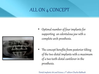 ALL ON 4 CONCEPT
• Optimal number of four implants for
supporting an edentulous jaw with a
complete arch prosthesis.
• The concept benefits from posterior tilting
of the two distal implants with a maximum
of a two teeth distal cantilever in the
prosthesis.
Dental implants Art and Science, 2nd edition Charles Babbush
 