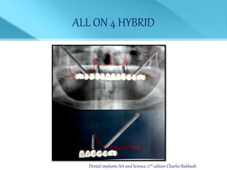 ALL ON 4 HYBRID
Dental implants Art and Science, 2nd edition Charles Babbush
 