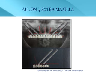 ALL ON 4 EXTRA MAXILLA
Dental implants Art and Science, 2nd edition Charles Babbush
 