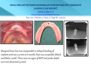 SINGLE IMPLANTRETAINEDMANDIBULAR OVERDENTUREWITHIMMEDIATE
LOADING(CASE REPORT)
Fariborz Vafaee,et al
Research Journal of Medical Sciences
Year: 2011 | Volume: 5 | Issue: 5 | Page No.: 273-275
Marginal bone loss was comparable to delayed loading of
implant and was 0.5 mm at 6 month, that was acceptable (Misch
and Bidez, 2008). There were no signs of BOP and probe depth
were not abnormal (3 mm).
 