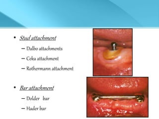 • Stud attachment
– Dalbo attachments
– Ceka attachment
– Rothermann attachment
• Bar attachment
– Dolder bar
– Hader bar
 