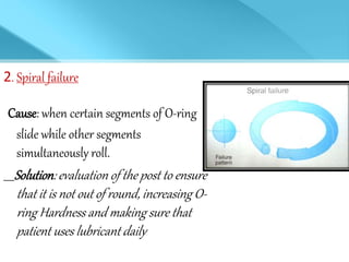2. Spiral failure
Cause: when certain segments of O-ring
slide while other segments
simultaneously roll.
Solution: evaluation of the post to ensure
that it is not out of round, increasing O-
ring Hardness and making sure that
patient uses lubricant daily
 
