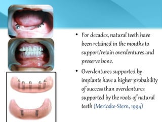 • For decades, natural teeth have
been retained in the mouths to
support/retain overdentures and
preserve bone.
• Overdentures supported by
implants have a higher probability
of success than overdentures
supported by the roots of natural
teeth (Mericske-Stern, 1994)
 