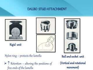 DALBO STUDATTACHMENT
Rigid unit
Ball and socket unit
(Vertical and rotational
movement)
Nylon ring – protects the lamella
  Retention – altering the positions of
free ends of the lamella
 