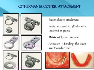 ROTHERMANECCENTRICATTACHMENT
Button shaped attachment
Patrix – eccentric cylinder with
undercut or groove
Matrix– Clip or clasp arm
Activation : Bending the clasp
arm towards center
Resilient unit
Rigid units
 