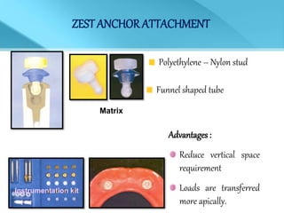 ZEST ANCHOR ATTACHMENT
Polyethylene – Nylon stud
Matrix
Funnel shaped tube
Instrumentation kit
Advantages :
Reduce vertical space
requirement
Loads are transferred
more apically.
 