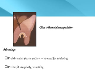 Clips with metal encapsulator
Advantage
Prefabricated plastic pattern – no need for soldering.
Precise fit, simplicity, versatility
 