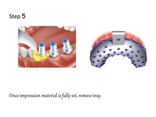 Step 5
Once impression material is fully set, remove tray.
 