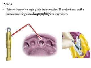 Step7
• Reinsert impression coping into the impression. The cut out area on the
impression coping should align perfectly into impression.
 