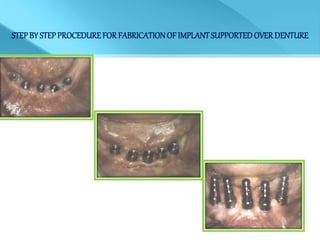 STEPBY STEPPROCEDUREFORFABRICATIONOF IMPLANTSUPPORTEDOVERDENTURE
 