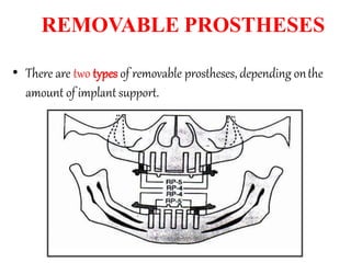 REMOVABLE PROSTHESES
• There are two types of removable prostheses, depending onthe
amount of implant support.
 