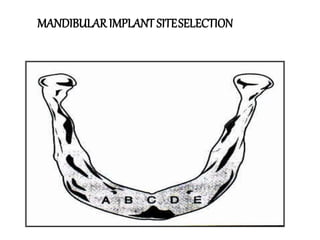 MANDIBULARIMPLANT SITESELECTION
 