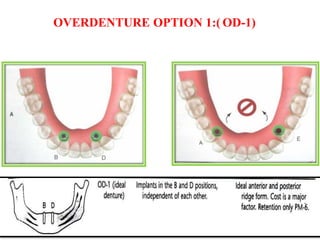 OVERDENTURE OPTION 1:( OD-1)
 