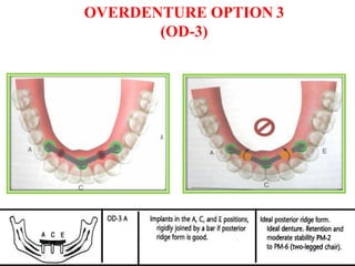 OVERDENTURE OPTION 3
(OD-3)
 