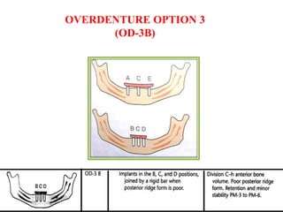OVERDENTURE OPTION 3
(OD-3B)
 