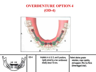 OVERDENTURE OPTION 4
(OD-4)
 