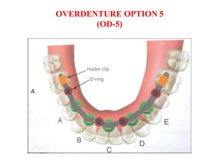 OVERDENTURE OPTION 5
(OD-5)
 