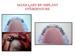 MAXILLARY RP- IMPLANT
OVERDENTURE
 