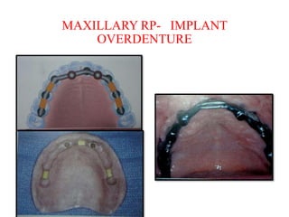 MAXILLARY RP- IMPLANT
OVERDENTURE
 